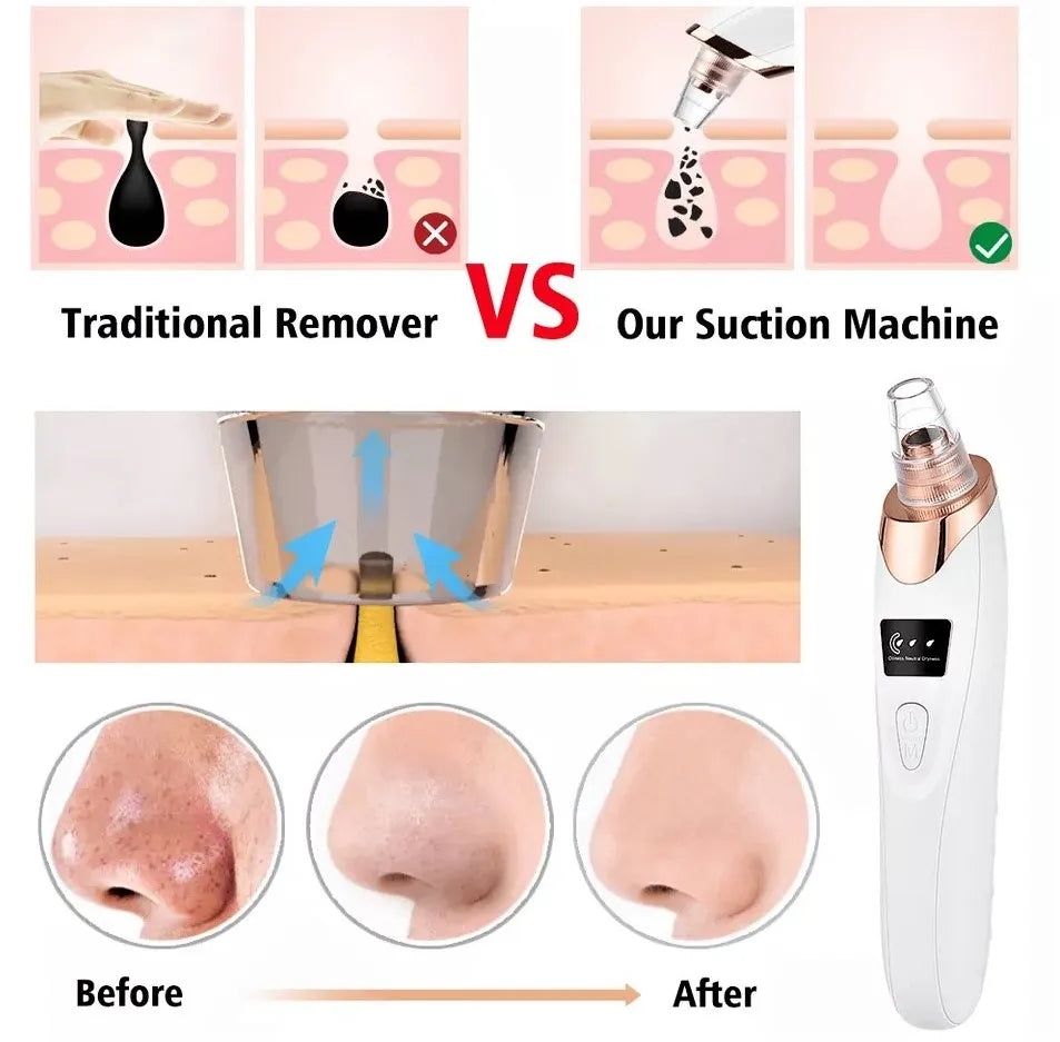 5in1 Blackhead Remover Machine Rechargeable | Face Vacuum Derma Suction With 5 Heads | Blackhead Removing Machine